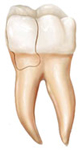 Fractured Cusp | Waterfront Endodontics